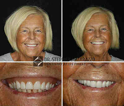 Who has dentures in Hollywood?