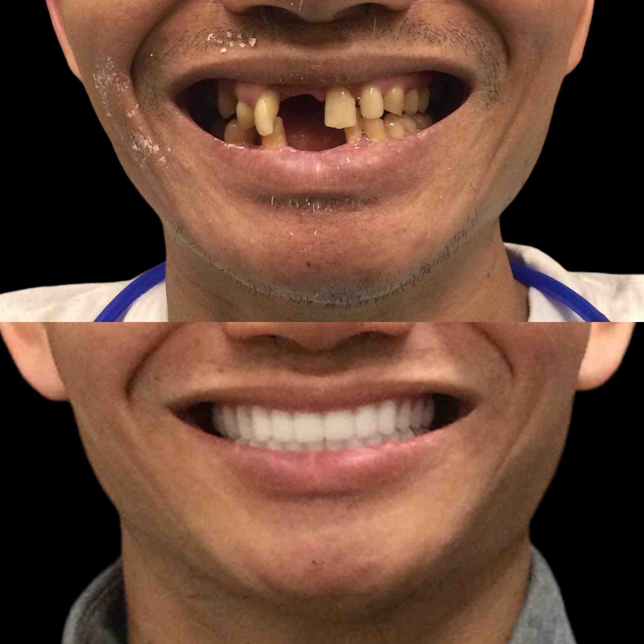 Who is not suitable for dental implants?