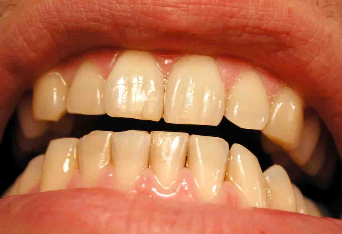 how-can-i-get-rid-of-yellow-teeth-dental-news-network