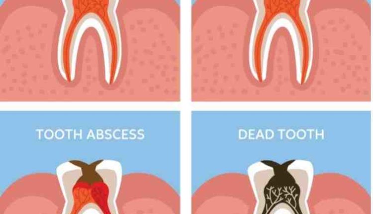 Why are root canals painful?