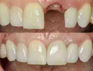 Why are tooth implants not covered by insurance?