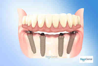 Why do gums recede around implant?