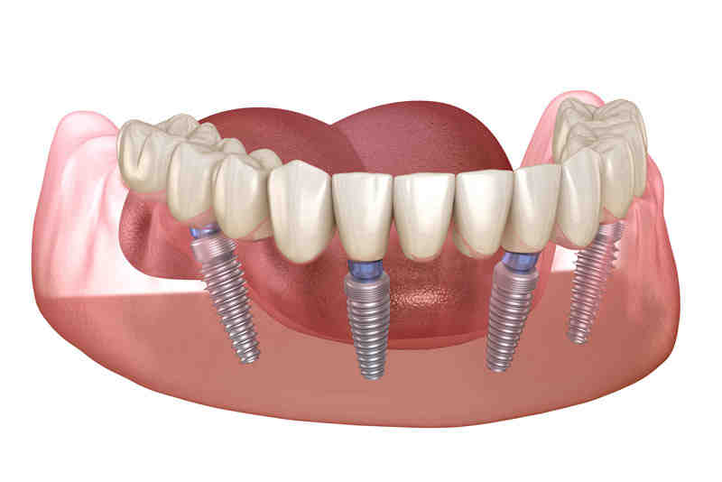 Why do gums recede around implant?