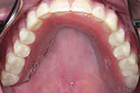 Why do some dentures look like horse teeth?