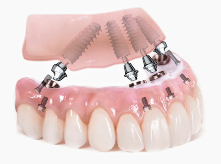 Why does my implant screw keep getting loose?