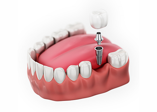 Why does the tooth next to my implant hurt?