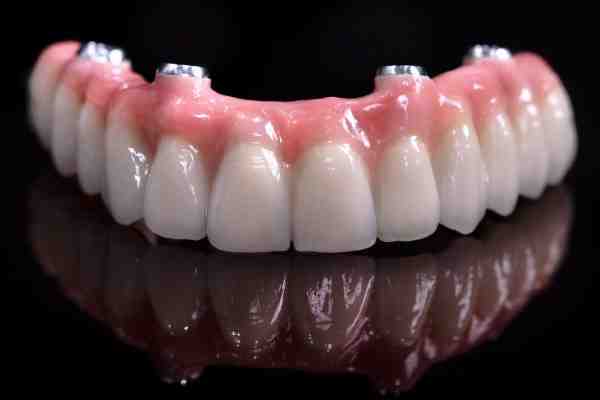Why is a doctor prefer bridge over implant?