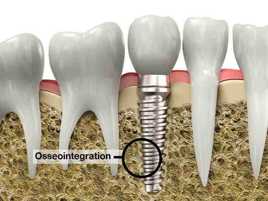 Why is my gum sore around my implant?