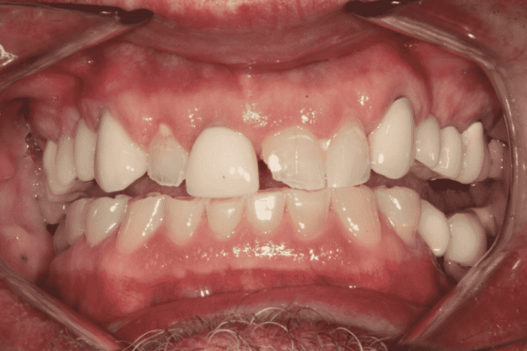 Why is my tooth black inside?