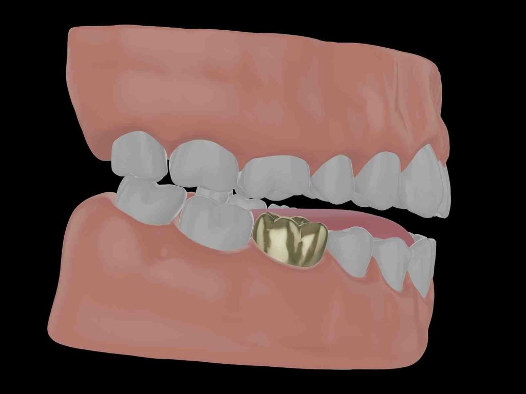 can-your-tooth-decay-under-a-crown-dental-news-network