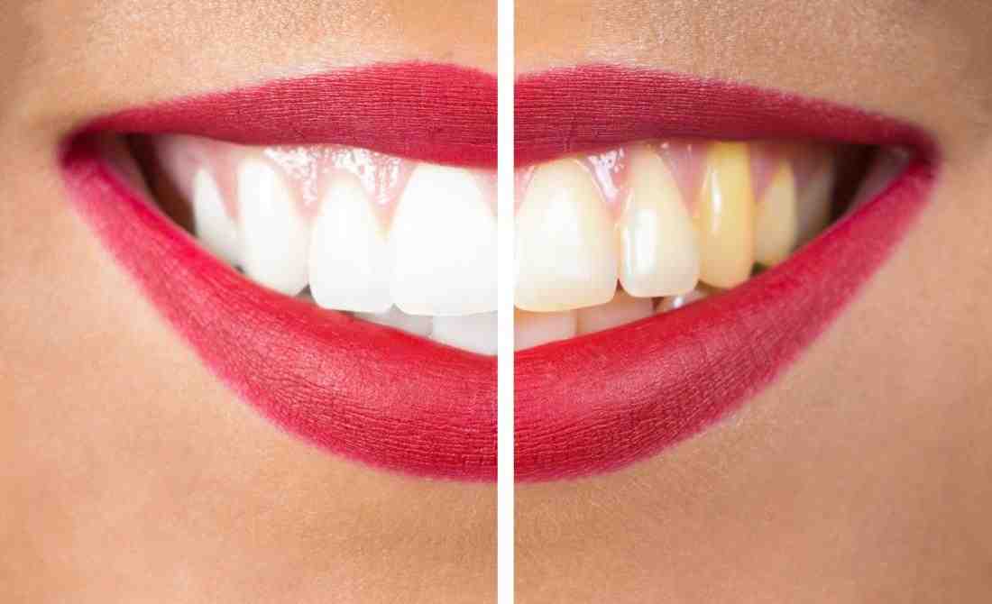 Why won't my teeth whiten?